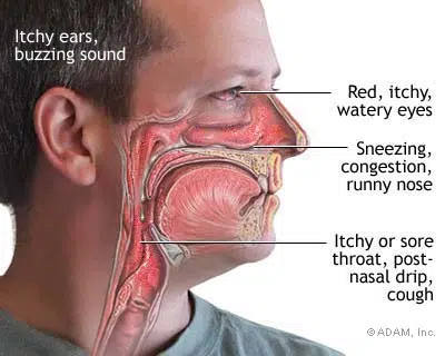 The Ultimate Guide to Hay Fever: Symptoms, Causes, and Powerful Prevention. 4 hay fever symptoms